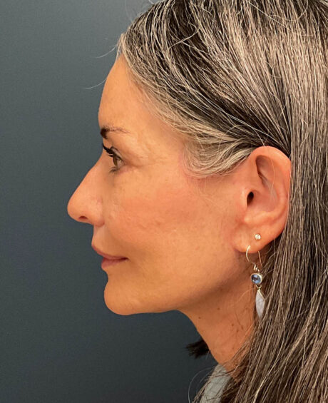 Eyelid Surgery case #20975
