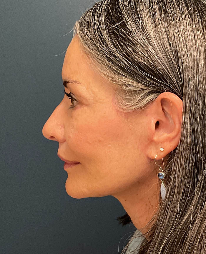 Eyelid Surgery case #20975