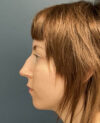 Rhinoplasty case #20967