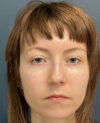 Rhinoplasty case #20967