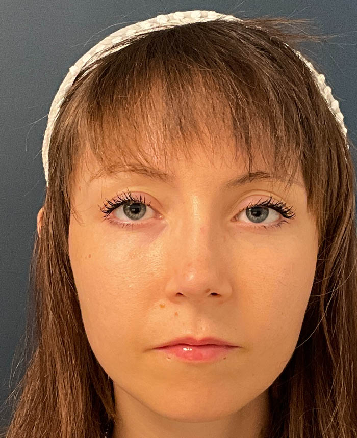 Rhinoplasty case #20967