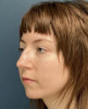 Rhinoplasty case #20967