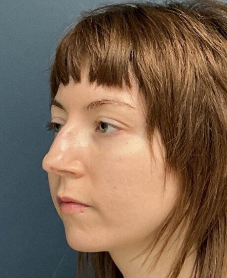 Rhinoplasty case #20967