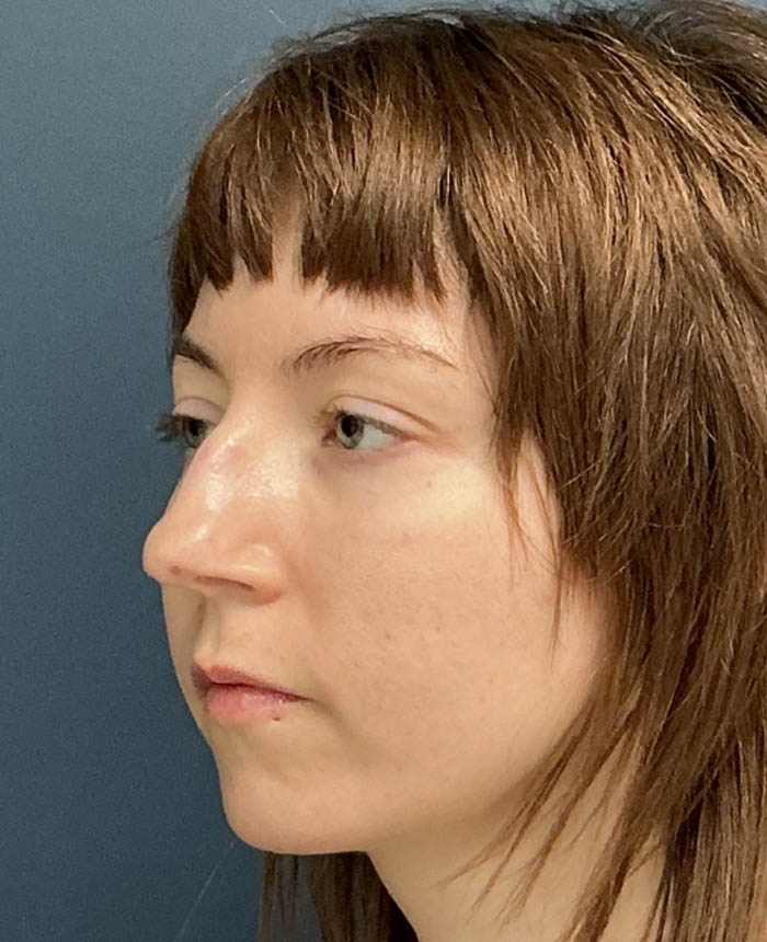 Rhinoplasty case #20967