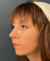 Rhinoplasty case #20967