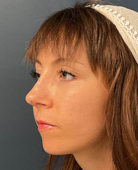 Rhinoplasty case #20967