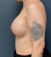 Breast Augmentation case #20939