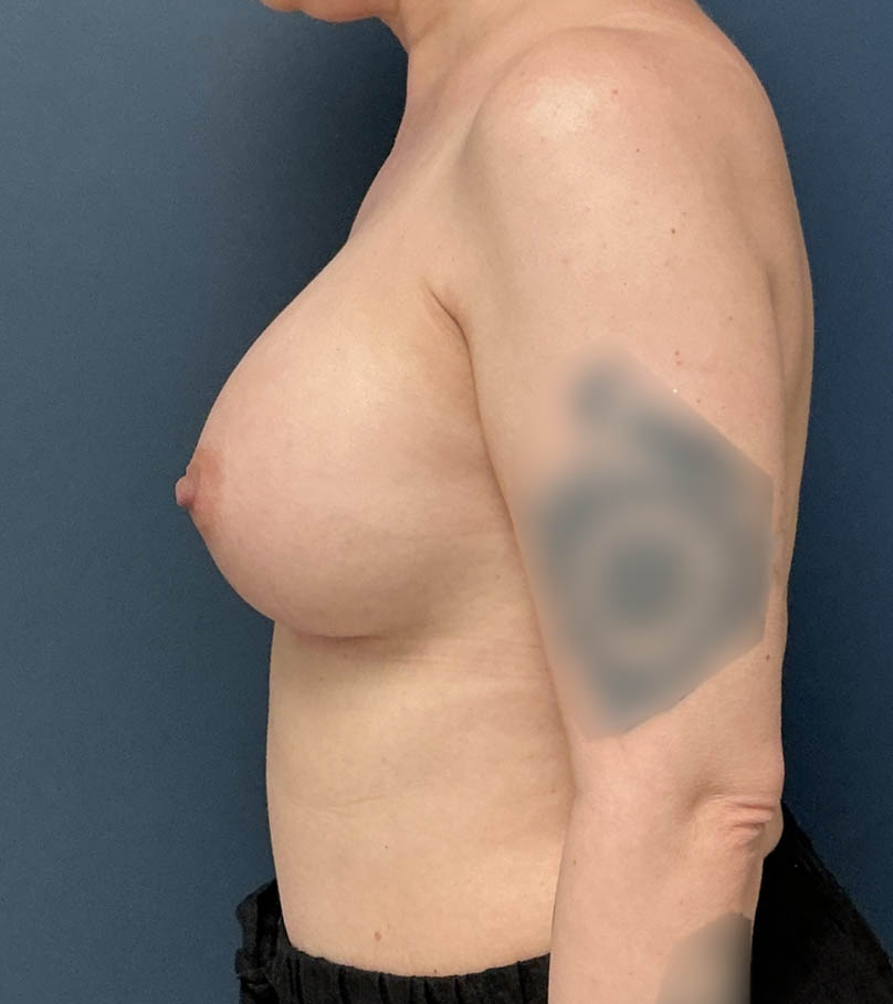 Breast Augmentation case #20939