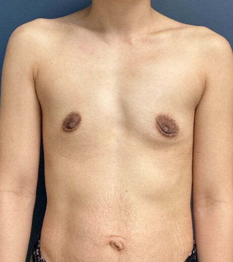 Breast Augmentation case #20947