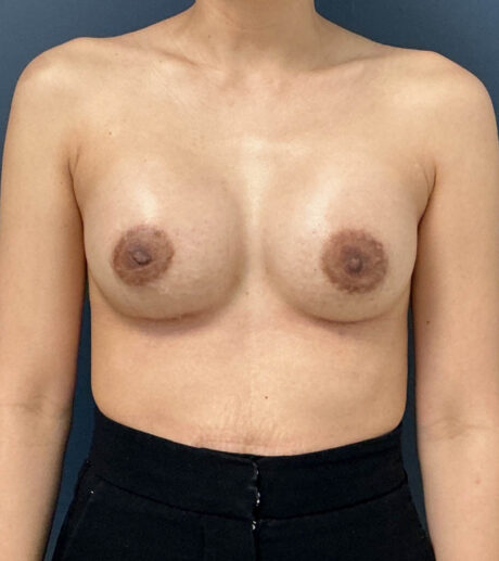 Breast Augmentation case #20947