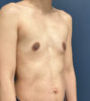Breast Augmentation case #20947