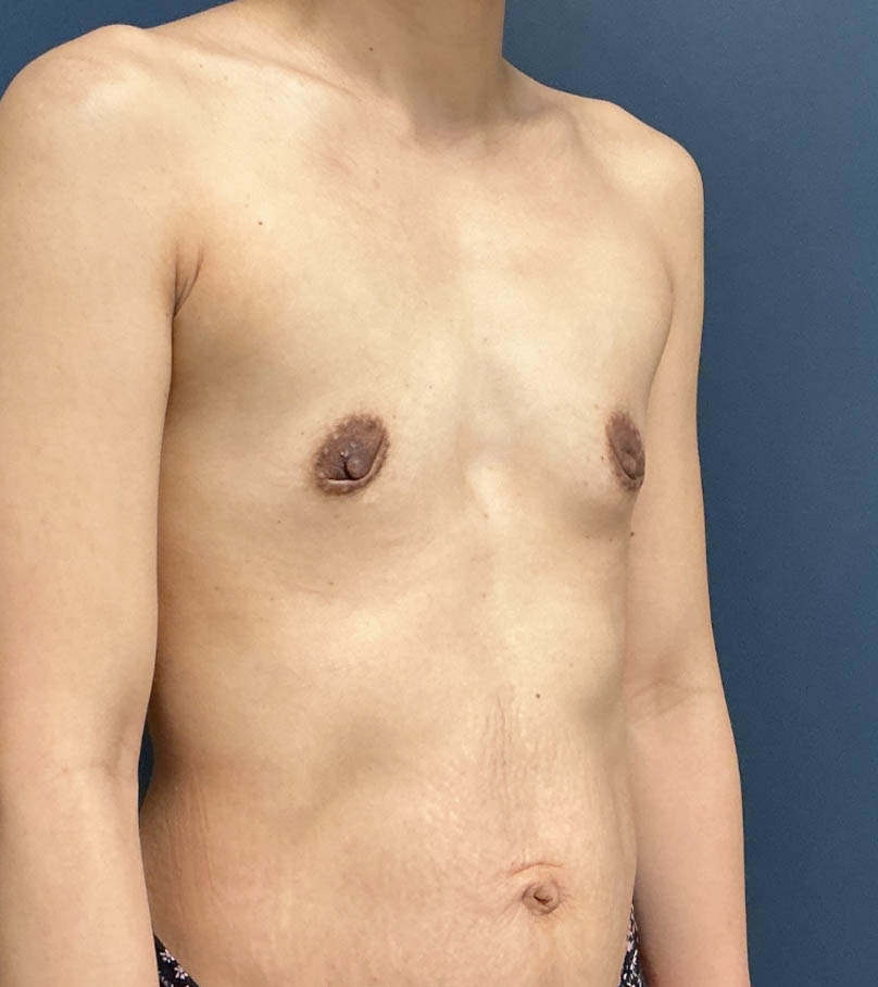 Breast Augmentation case #20947