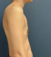 Breast Augmentation case #20947
