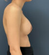 Breast Augmentation case #20947