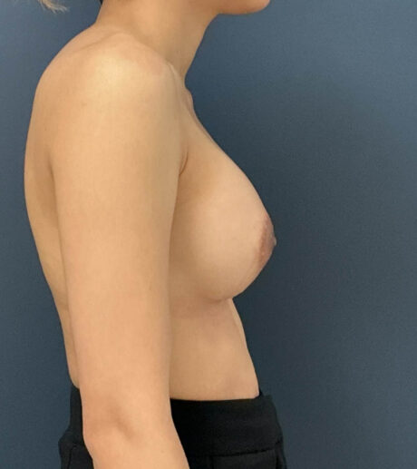 Breast Augmentation case #20947