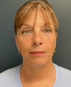 Eyelid Surgery case #20860