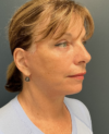 Eyelid Surgery case #20860