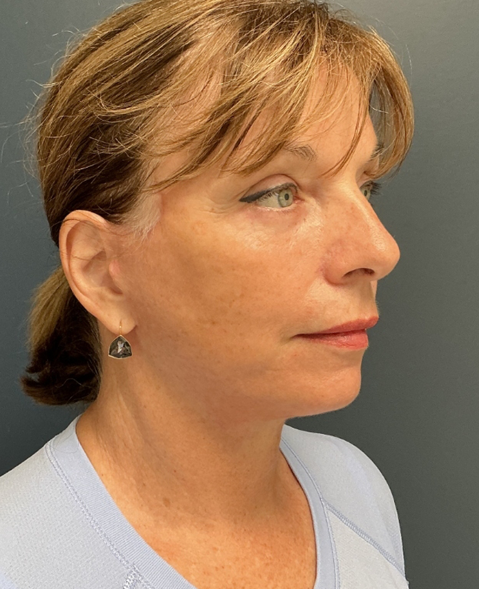 Facelift case #20842