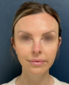 Rhinoplasty case #20862