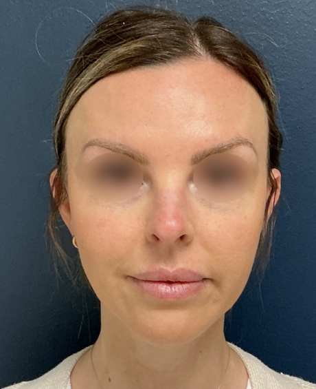 Rhinoplasty case #20862