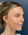 Rhinoplasty case #20862