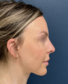Rhinoplasty case #20862