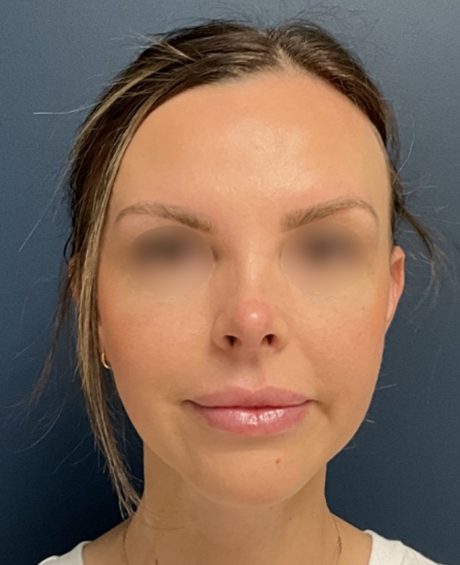 Rhinoplasty case #20862