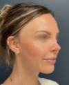 Rhinoplasty case #20862