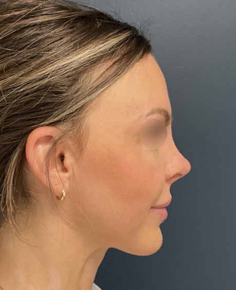 Rhinoplasty case #20862