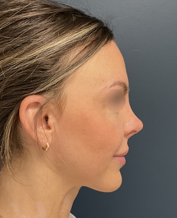 Rhinoplasty case #20862