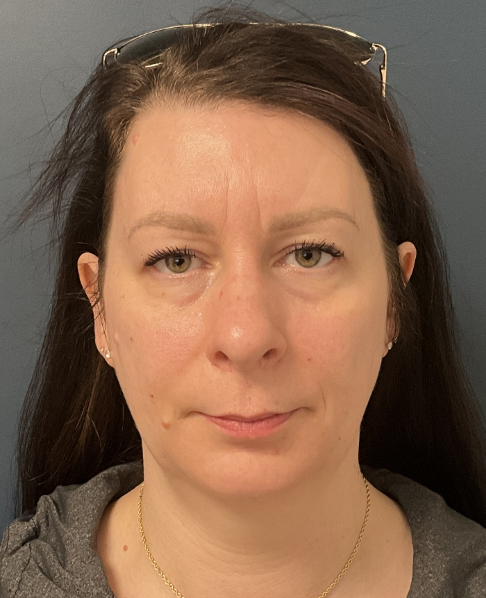 Facelift case #20852
