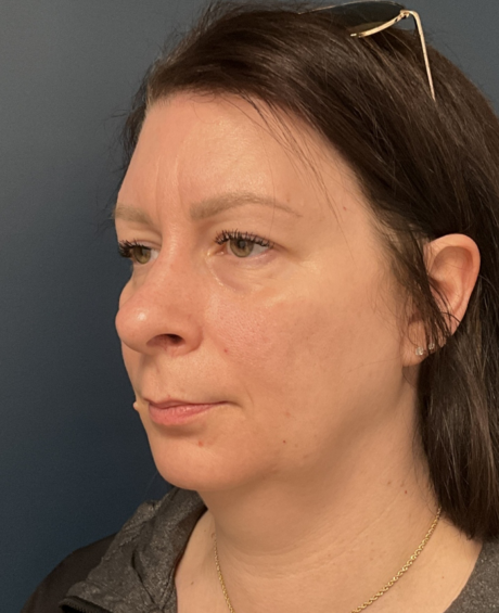 Facelift case #20852