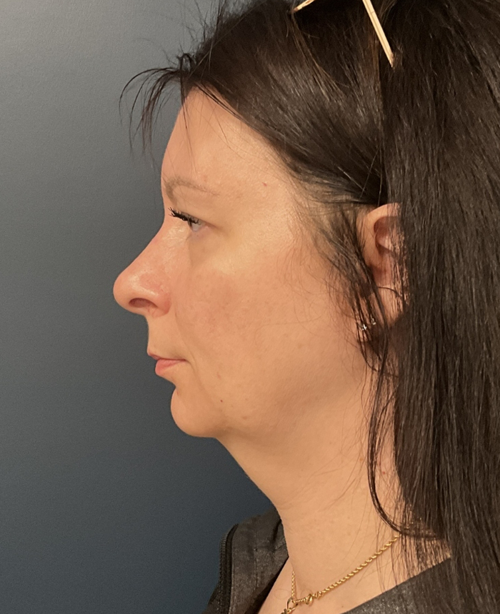 Facelift case #20852