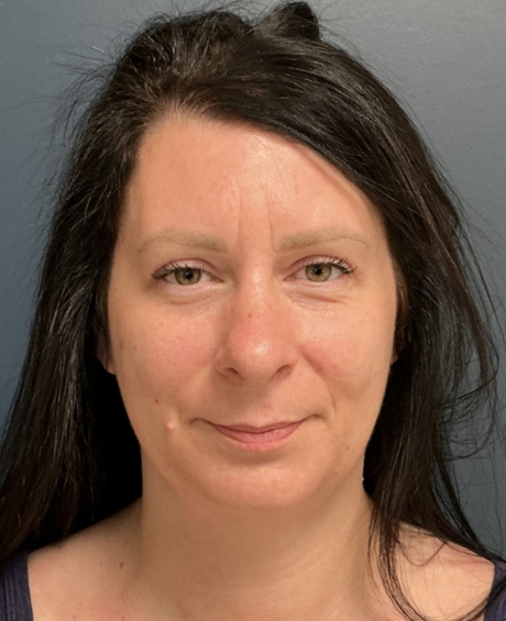 Facelift case #20852