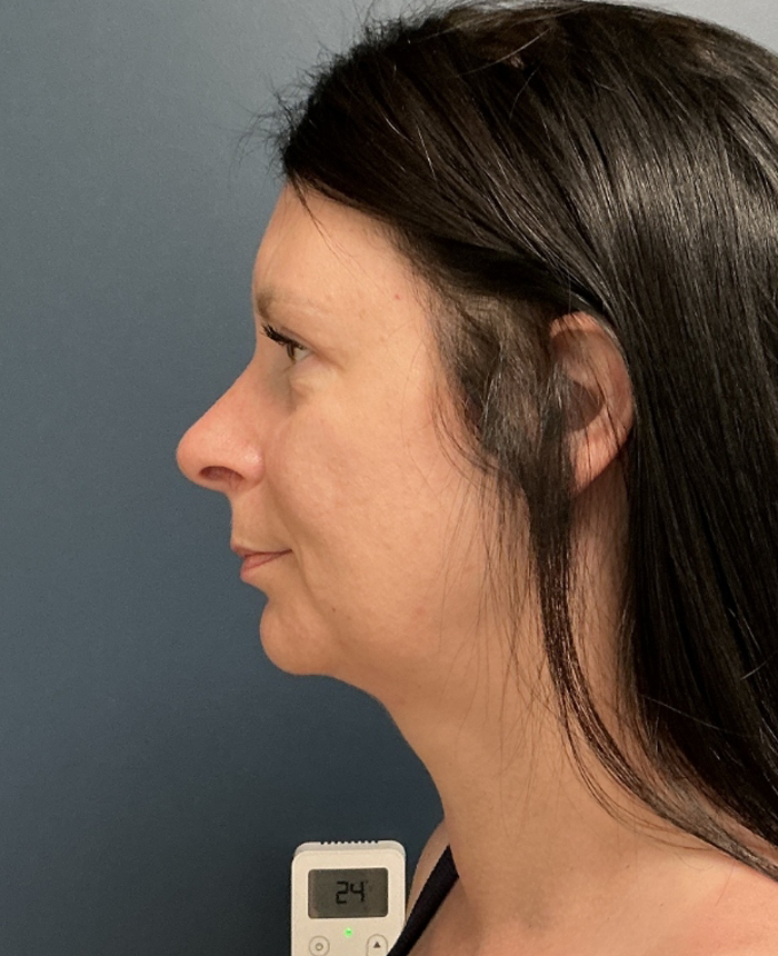 Facelift case #20852