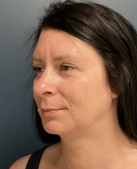 Facelift case #20852