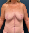 Breast Lift case #21009