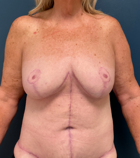 Breast Lift case #21009