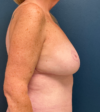 Breast Lift case #21009