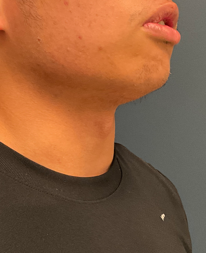 Gender Affirming Surgery case #20985