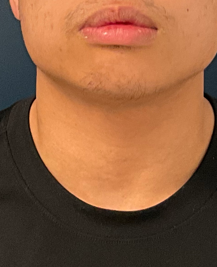 Gender Affirming Surgery case #20985