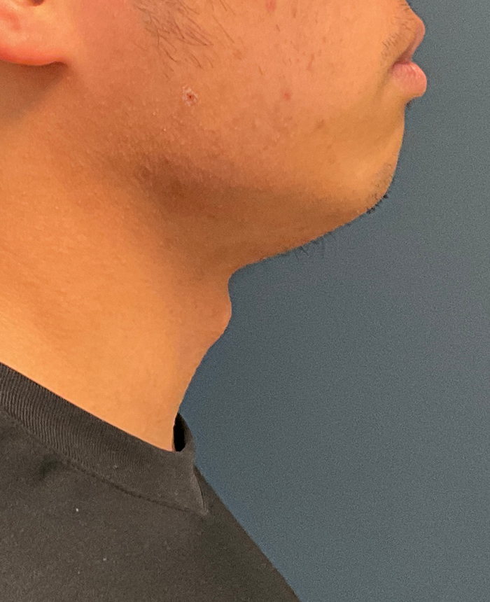 Gender Affirming Surgery case #20985
