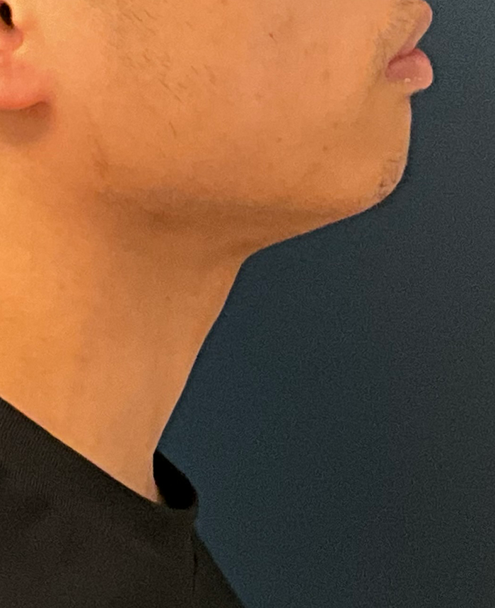 Gender Affirming Surgery case #20985