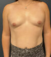 Breast Augmentation case #21111
