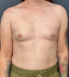 Breast Augmentation case #21152