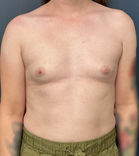 Breast Augmentation case #21152