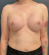 Breast Augmentation case #21152
