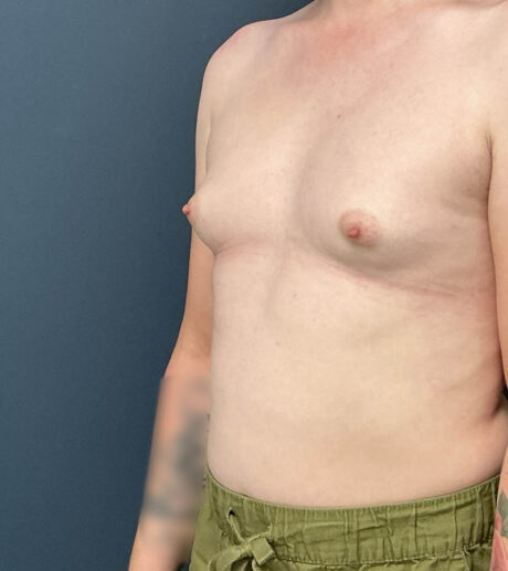 Breast Augmentation case #21152