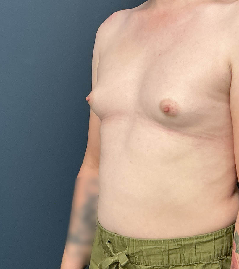 Breast Augmentation case #21152