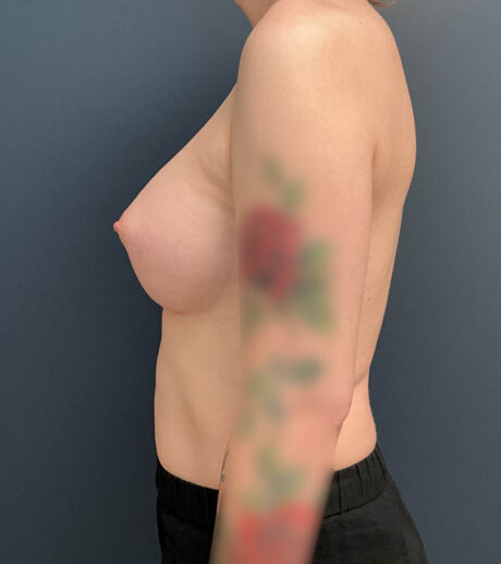 Breast Augmentation case #21152